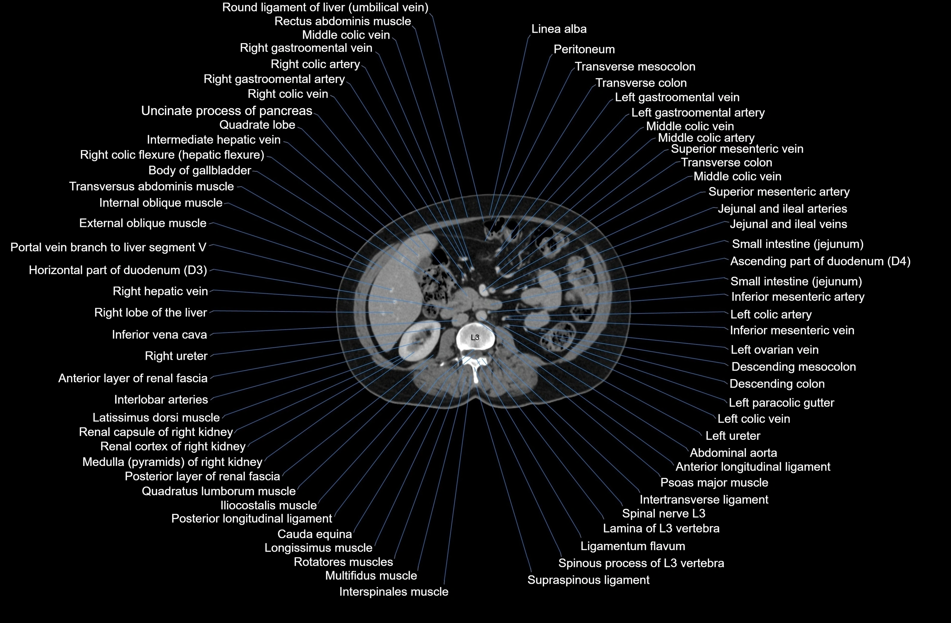 CT Abdomen axial cross sectional anatomy labelled radiology image-00044.webp